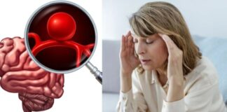 Síntomas de un aneurisma que confundes con un dolor de cabeza