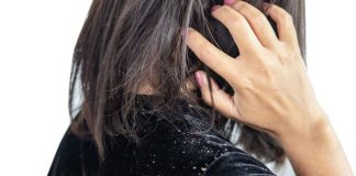 7 remedios caseros para eliminar la caspa de tu cuero cabelludo
