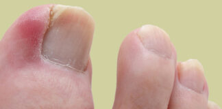 uñeros