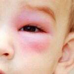 Advierten que traumas oculares son un peligro para la visión de infantes 