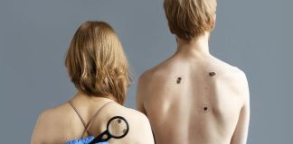 Altas temperaturas aumenta el riesgo de cáncer de piel en las personas