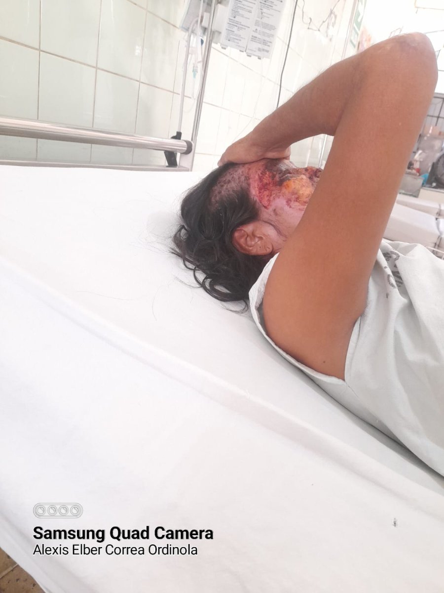 Mamita con quemaduras de tercer grado en el rostro necesita ser trasladada a hospital en Lima.