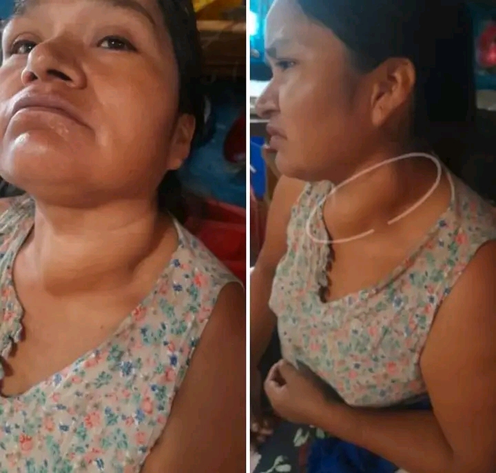 Huancabamba: madre de familia pide apoyo para tratamiento médico.