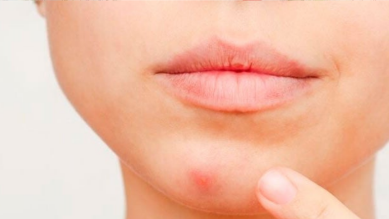 ¿Cómo quitar un grano inflamado y rojo sindejar marca en la piel?