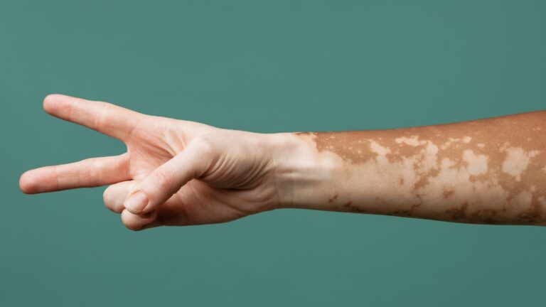 Vitiligo: ¿por qué se da y cómo se trata?