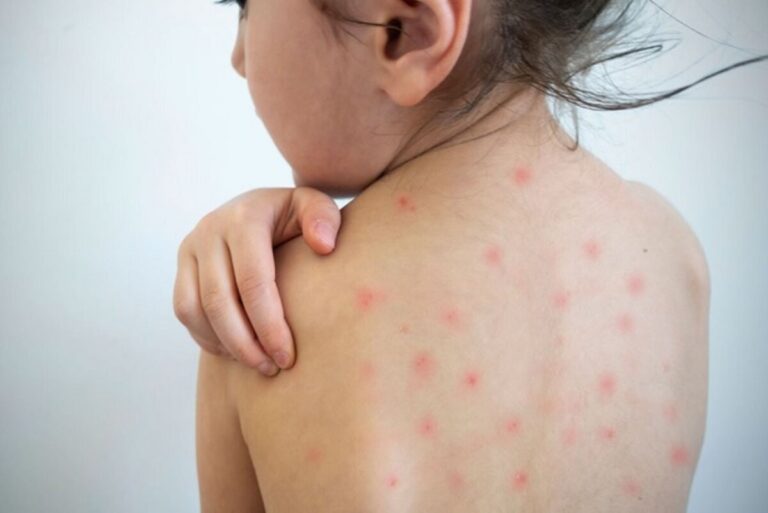 Ministerio de Salud emite una alerta epidemiológica por riesgo de importación de casos de sarampión