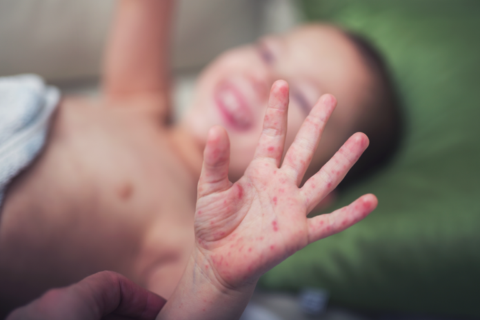¿Qué es el síndrome mano, pie y boca y cómo afecta a los niños?