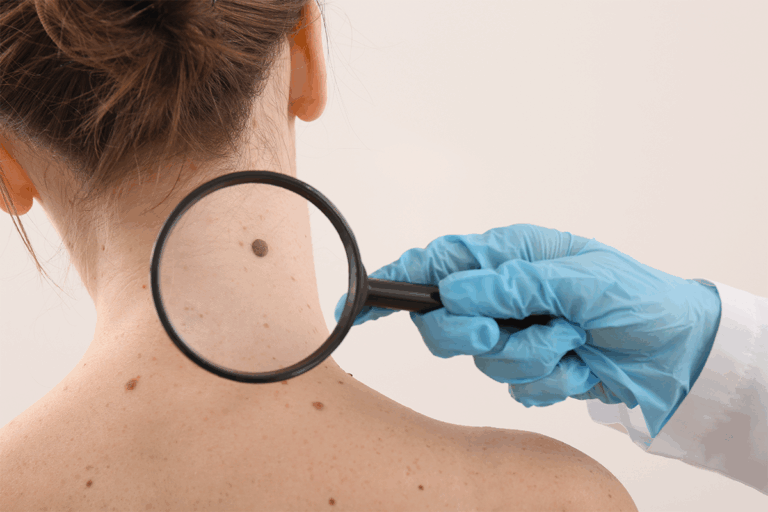 Cáncer de piel: prevención, tipos y cuidados necesarios