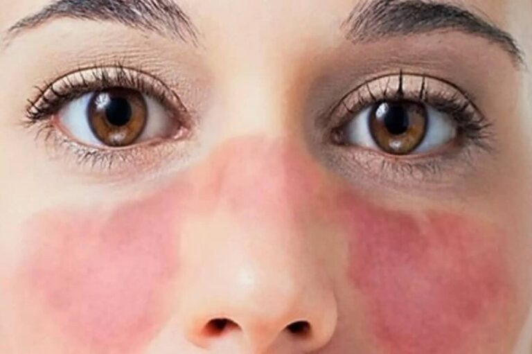 ¿Qué es el lupus? Conoce sus síntomas, factores de riesgo y tratamiento