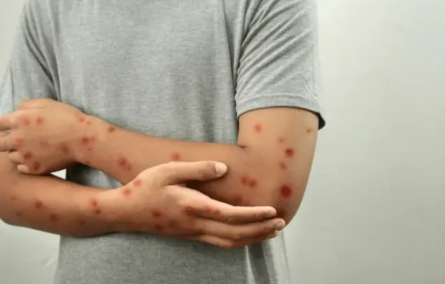 Viruela del mono: conoce los síntomas, formas de contagio y prevención