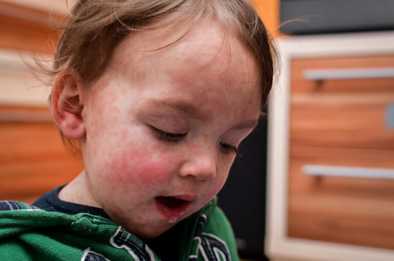 Alergias en niños: conoce cómo identificarlas, prevenirlas y tratarlas