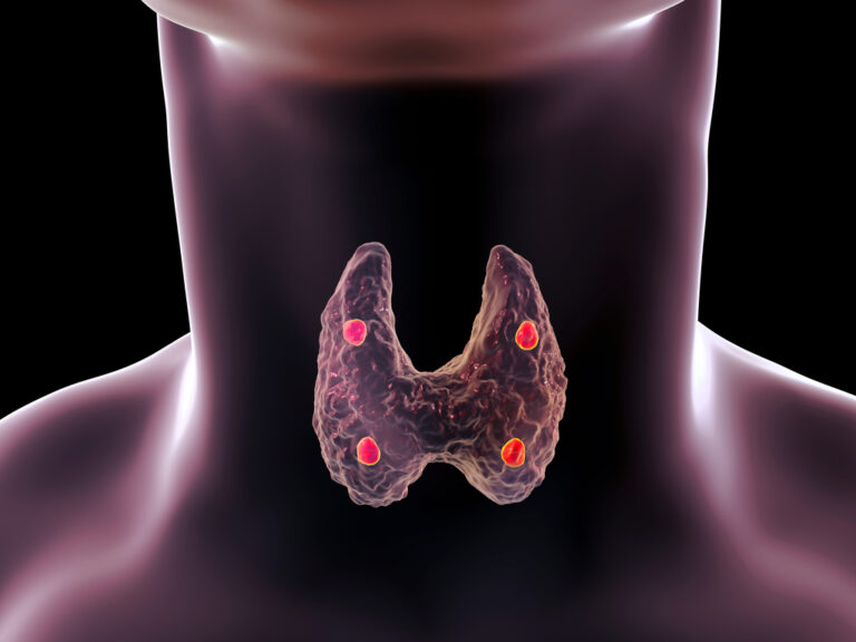 Conoce el cáncer de tiroides: causas, factores de riesgo y cómo prevenirlo