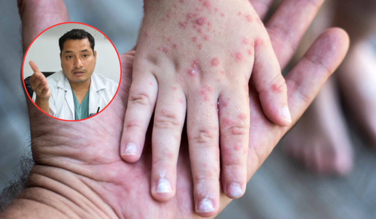 La alerta sanitaria se incrementa tras la confirmación de múltiples casos de sarampión en Puno.